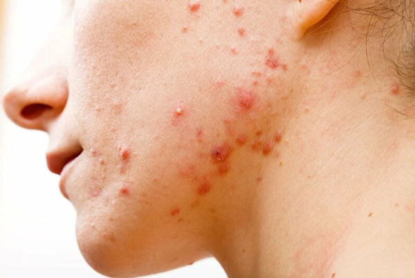 Viêm nang lông dẫn tới tình trạng mụn và da mặt bị ngứa